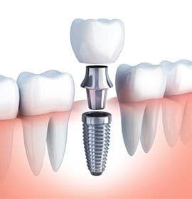 Animation of dental implant tooth replacement process