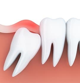 Animation of impacted tooth
