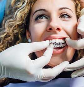 Dentist placing clear aligner on smiling patient