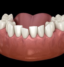 Example of crowded teeth in Brampton that Invisalign can fix