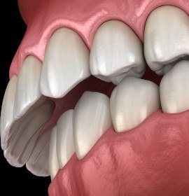 Example of an overbite in Brampton that Invisalign can fix