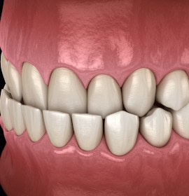 Example of an underbite in Brampton that Invisalign can fix