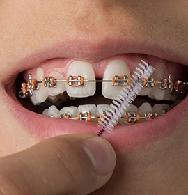 a teen cleaning the archwire of their braces