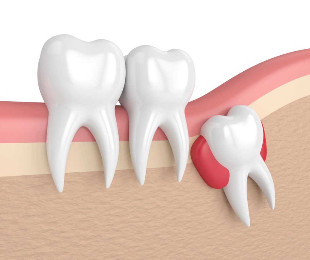 Impacted Tooth Warning Signs Salvaggio Dentistry