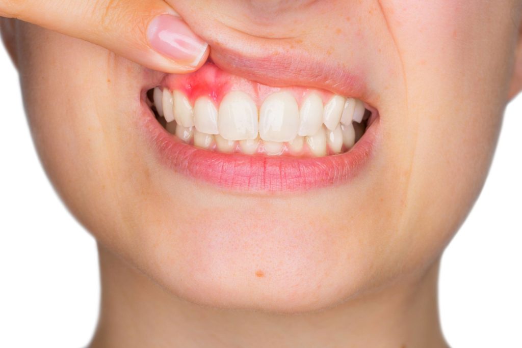 what-you-should-know-about-gum-inflammation-brampton-dentist