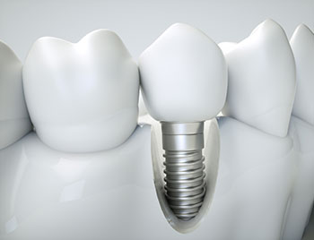 brampton dental implant dentist gta